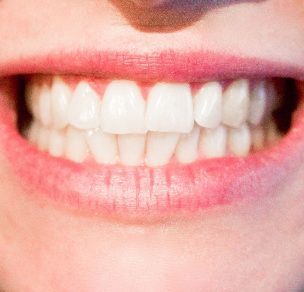 5 cosas a saber sobre el blanqueamiento dental