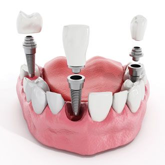 Perquè la meva boca rebutja l'implant dental?