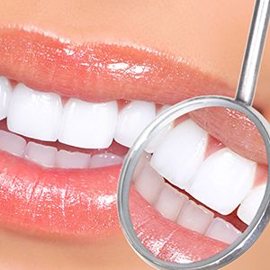5 Preguntes freqüents de la neteja dental