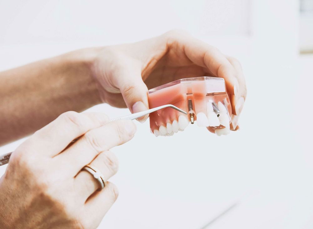 Get your smile back in just one day thanks to dental implants