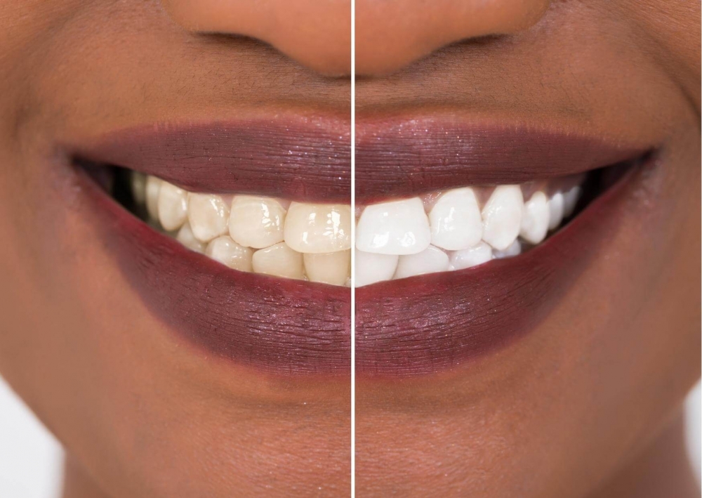 Beneficios y consecuencias del blanqueamiento dental
