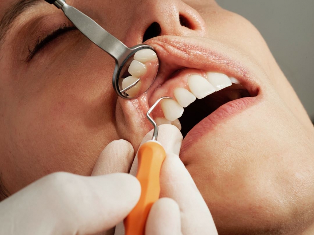 ¿Qué es el sellado dental y cómo se aplica?