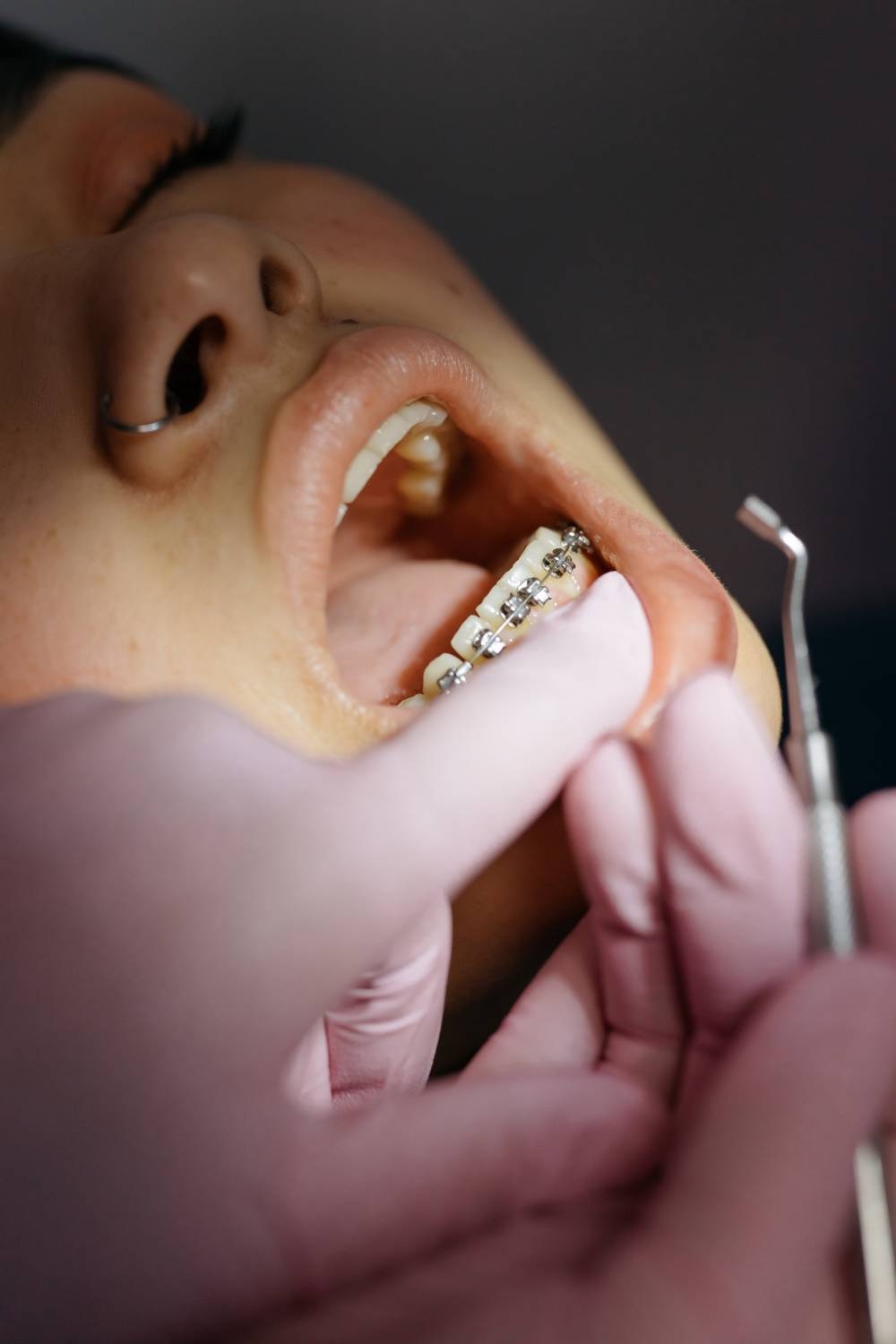Oclusión dental