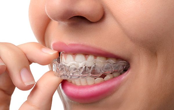 Questions about Invisalign