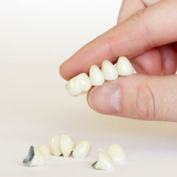¿Qué son las coronas dentales?