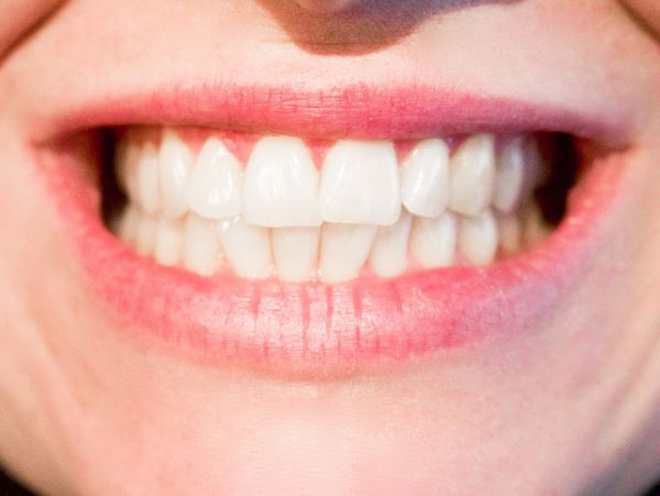 5 things you should know about dental whitening