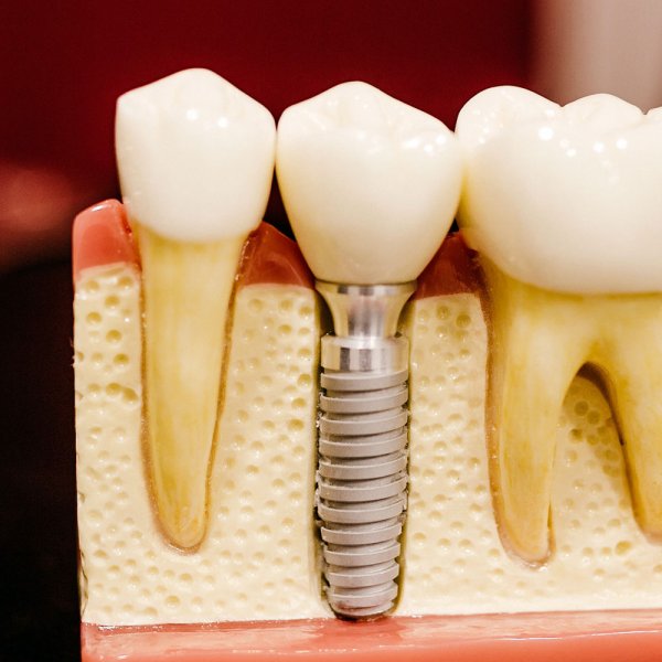 Implantes dentales en pacientes que han padecido cáncer