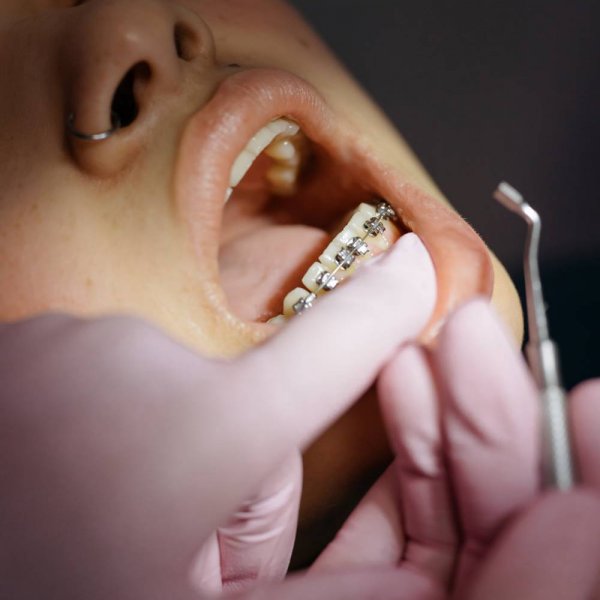 Oclusión dental