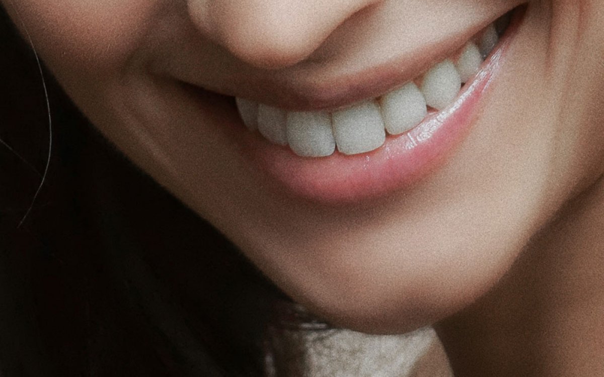 Les 10 preguntes més freqüents sobre implants dentals